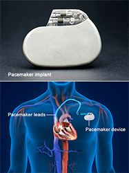 Permanent Pacemaker Melbourne | Implant Surgery St Albans, Richmond ...